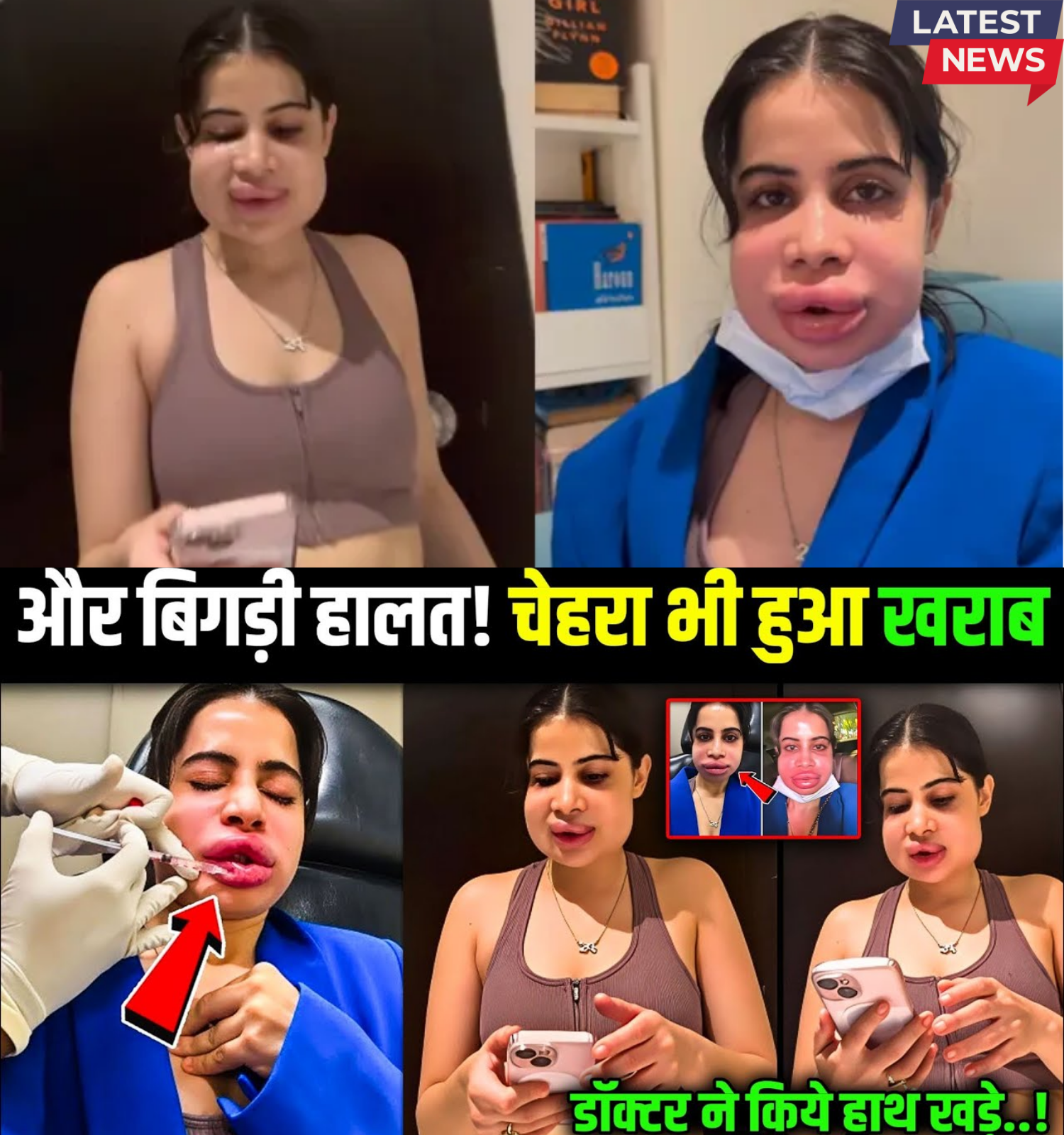 SHOCKING TRANSFORMATION Urfi Javed’s Face Swells After Lip Procedure