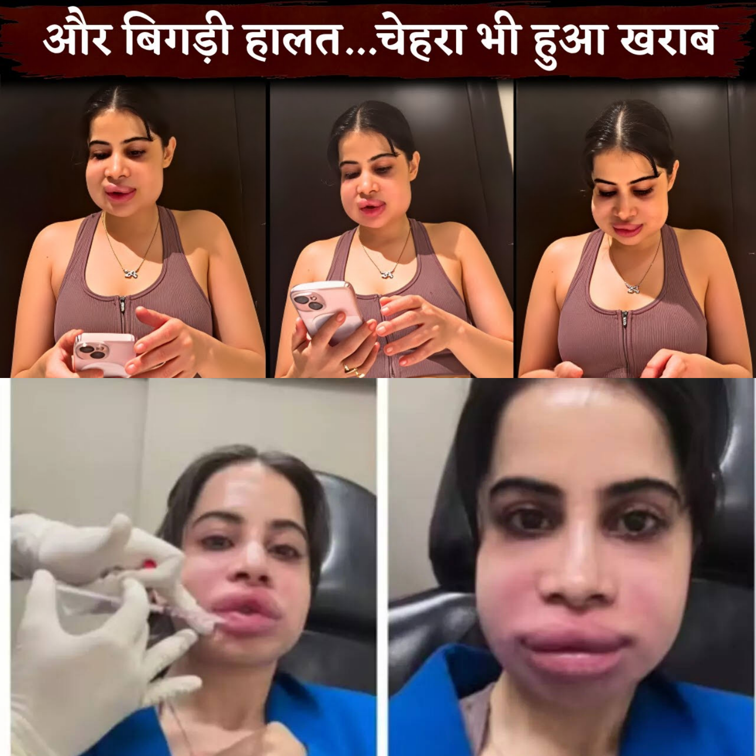 You Won’t Believe What Happened to Urfi Javed After Her Lip Procedure